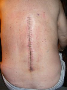 SPINAL SCARS